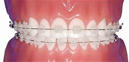 Ceramic Brackets, 20 kit