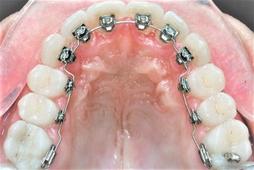 Lingual Rectangular NiTi Arch Wires